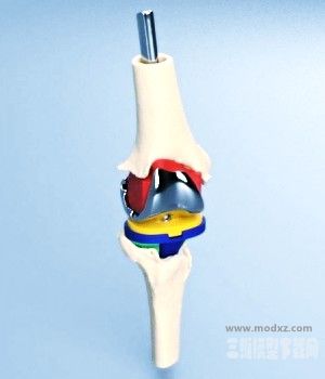 膝关节置换3D模型下载